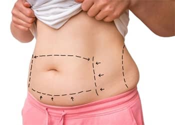 Tumescent Liposuction Procedure